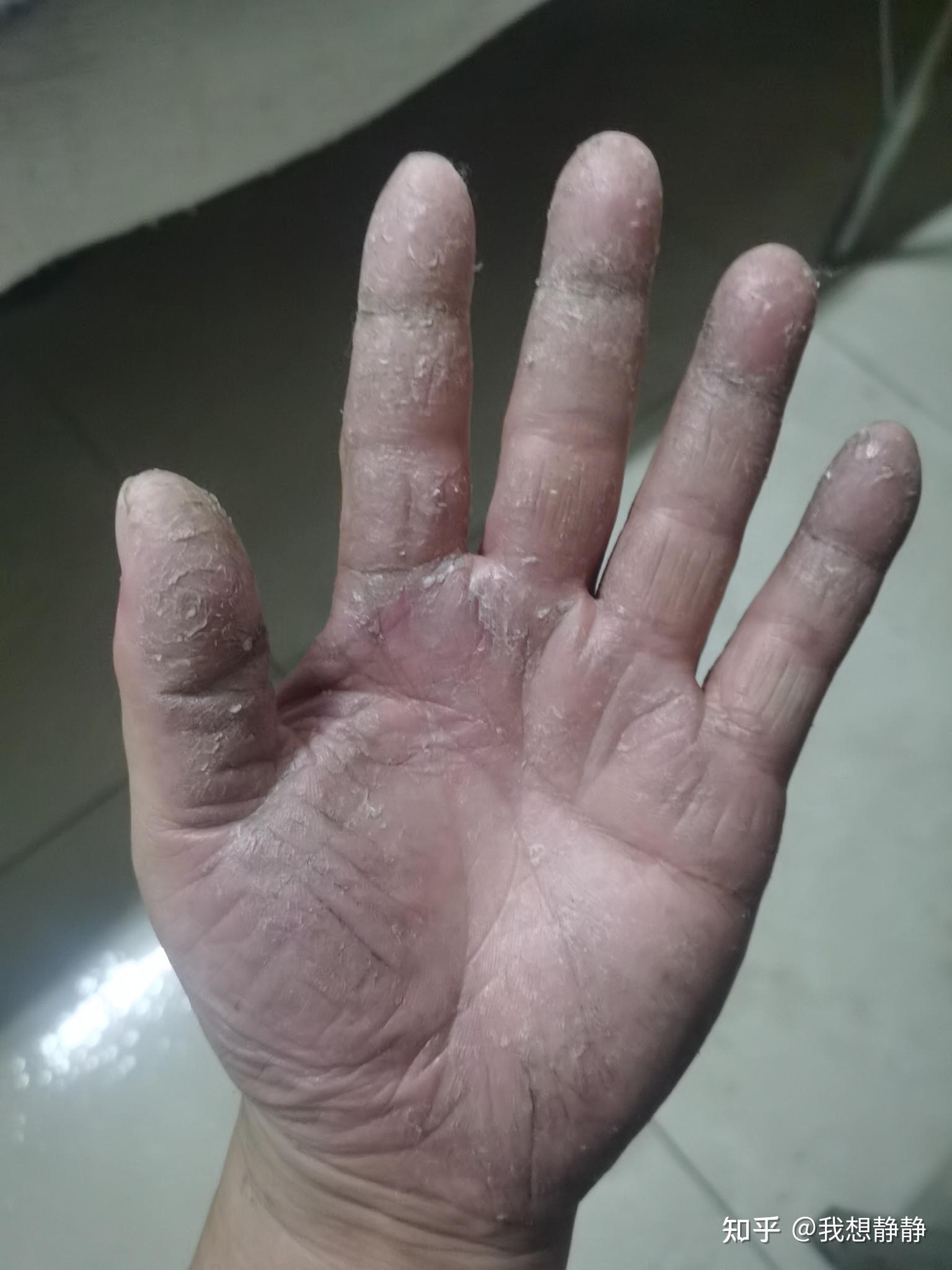 一到秋天转冬天的时候,手掌就呈现红色的斑块,会痒,摸起来也比较硬