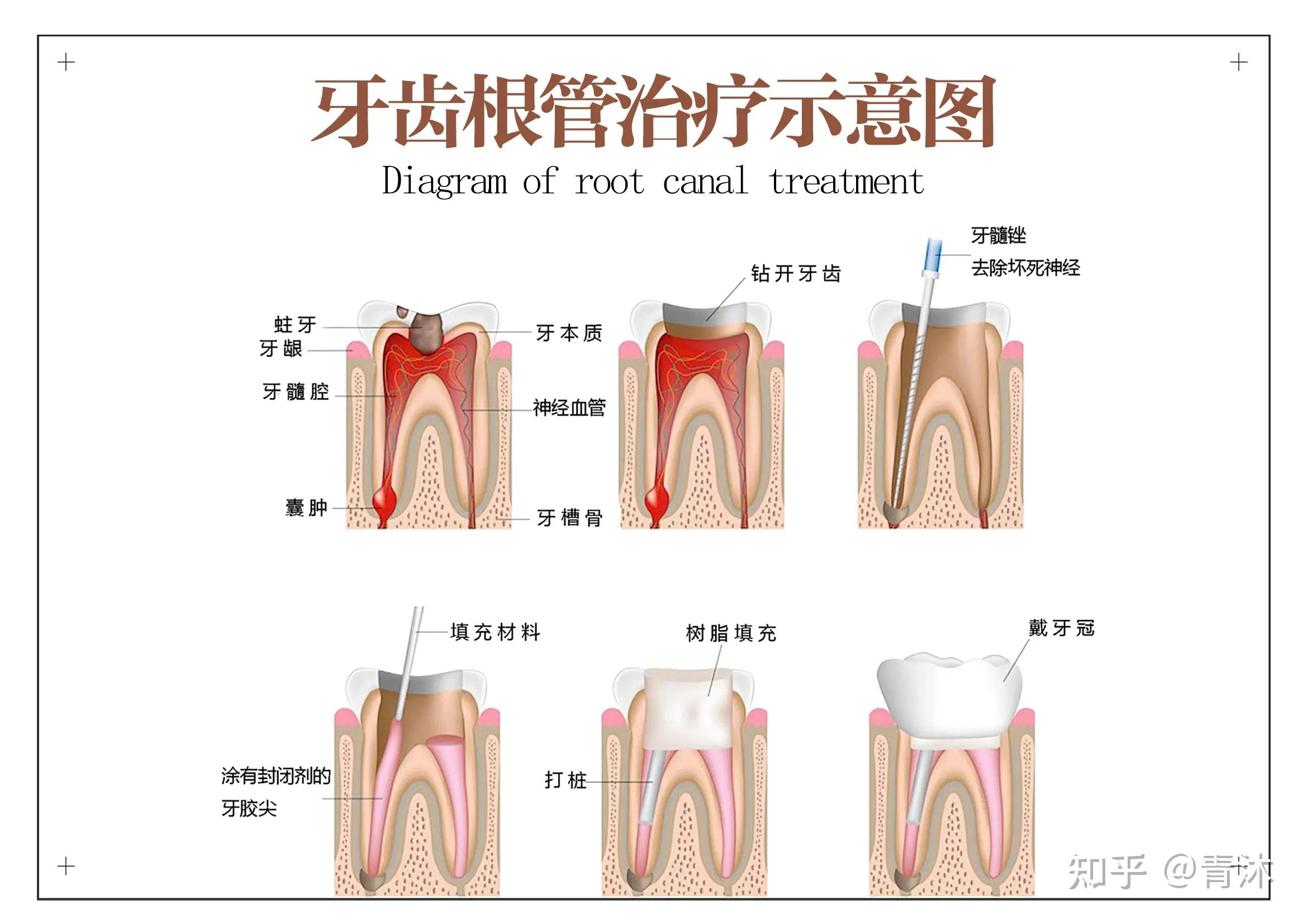 根管治疗一般多少钱? - 知乎