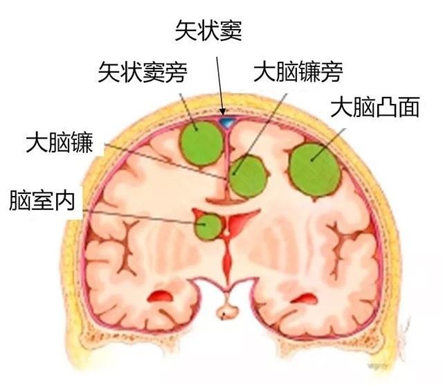 不同位置的脑膜瘤都有哪些症状表现