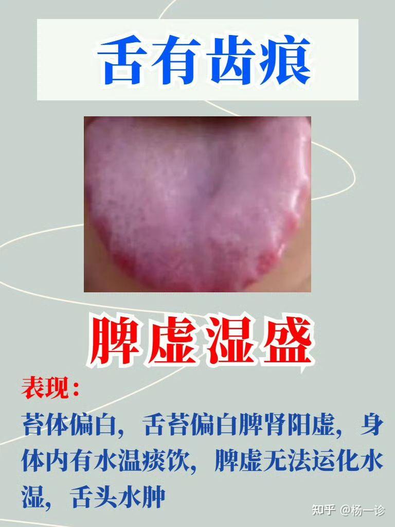 中医舌诊案例分析。 - 知乎