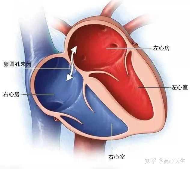 头疼?原来是心脏出毛病了! - 知乎