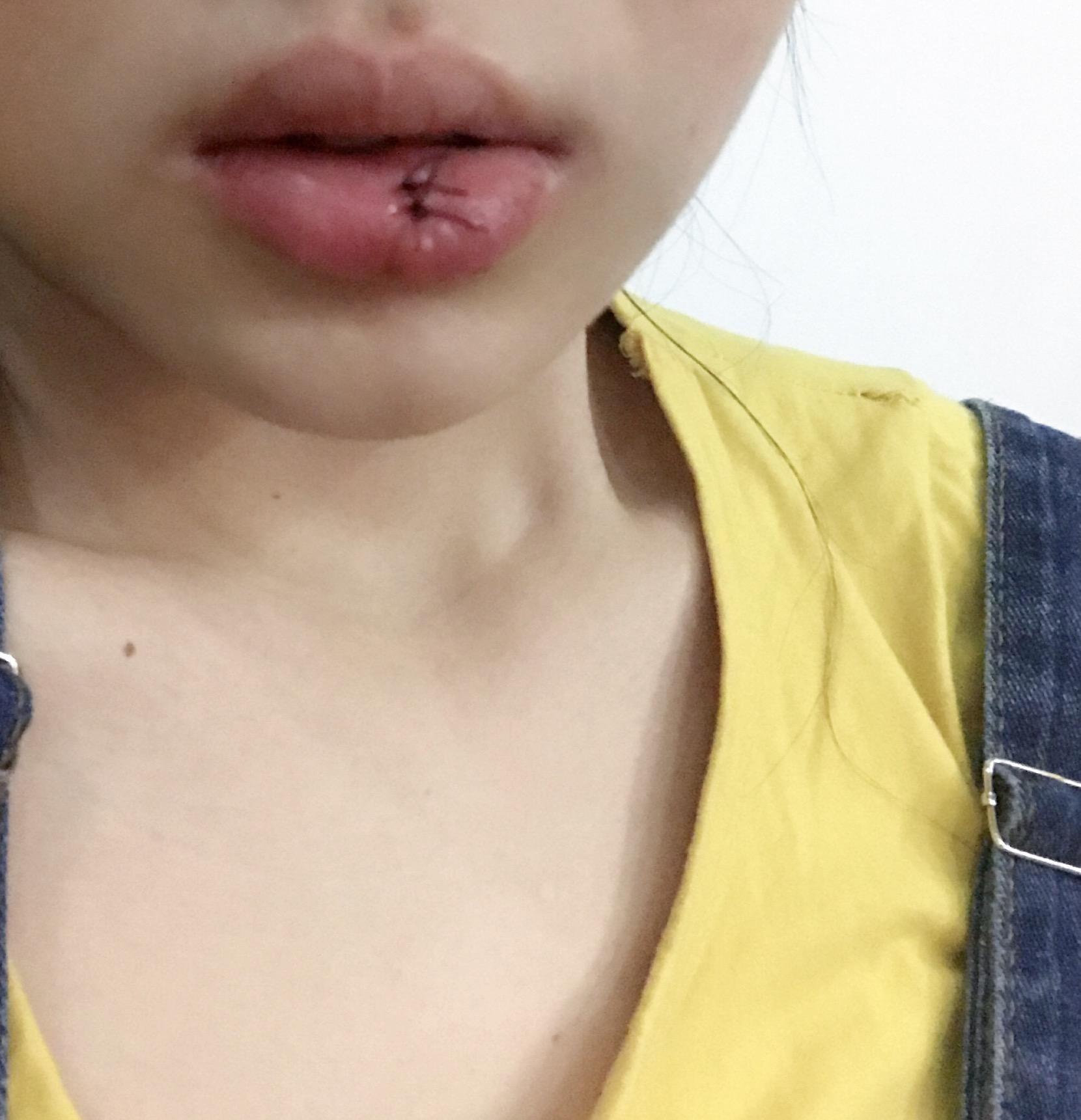 嘴唇上最近长了几个黑点像痣又像斑怎么能去除