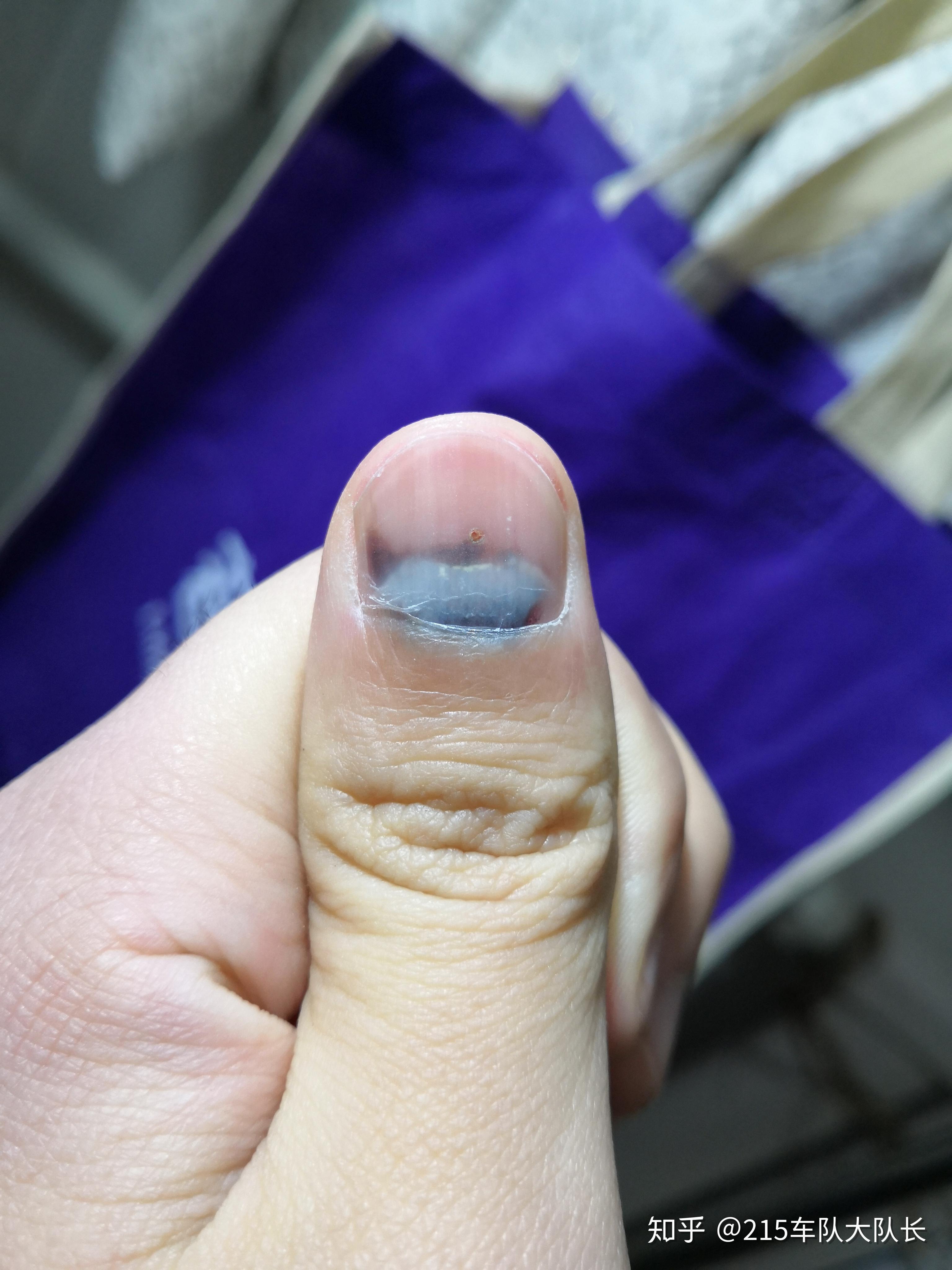 手指被夹,指甲根部发黑,一直疼痛,怎么办? - 知乎