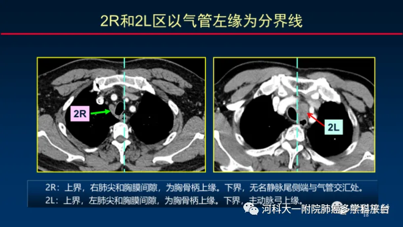 纵隔淋巴结分区ct图谱