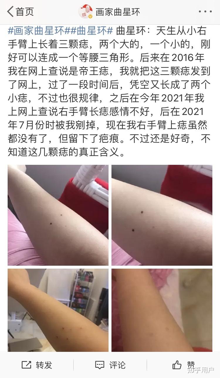 画家曲星环右手臂上是不是有三颗痣能连成等腰三角形? - 知乎