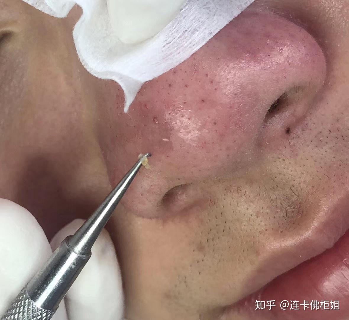 为什么针清挤黑头视频里,挤出来的黑头经常都被放在手套上? - 知乎