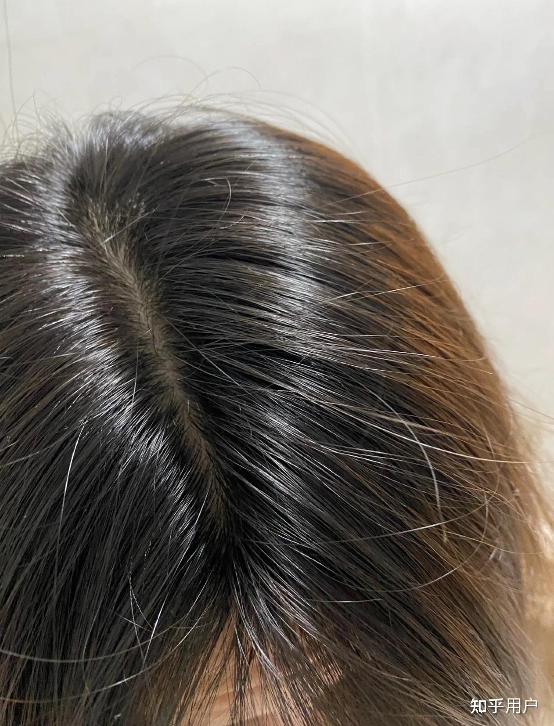 女生 发量少 头顶快秃了 有没有什么好的生发方法!跪求! - 知乎