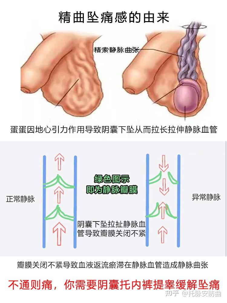 睾丸静脉曲张外观图图片