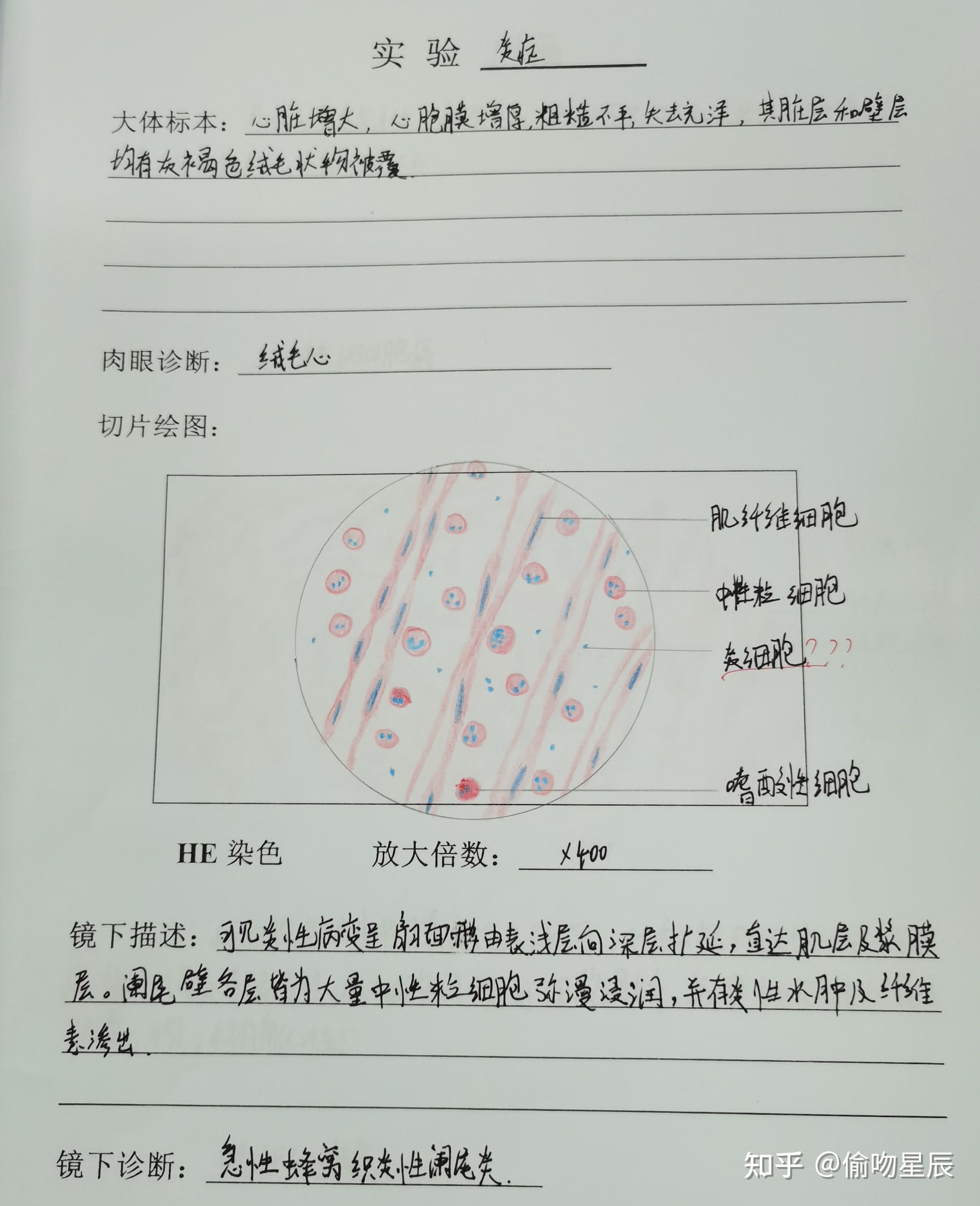 有没有人有病理的结肠腺癌红蓝铅笔手绘图啊? - 知乎