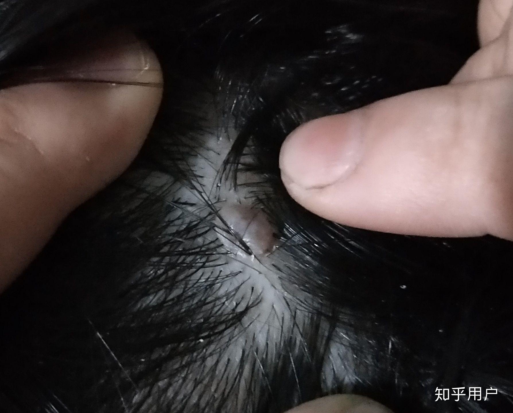 头皮上长了一个红色的小肉球不疼不痒的问一下是啥? - 知乎