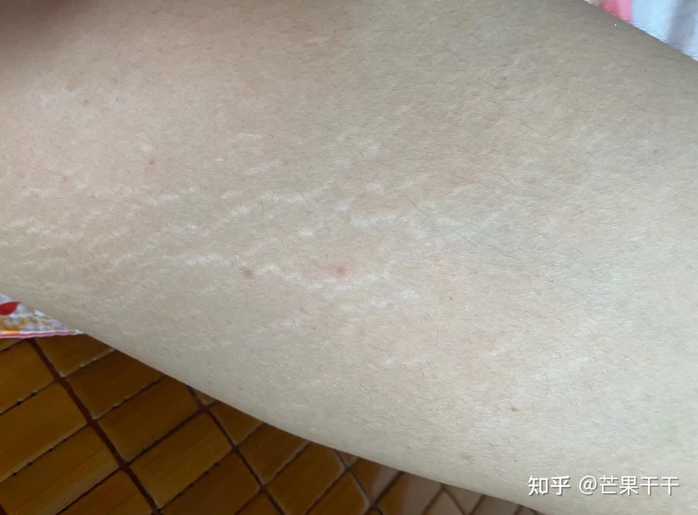 一百斤不到的我居然有肥胖纹?怎么办? - 知乎