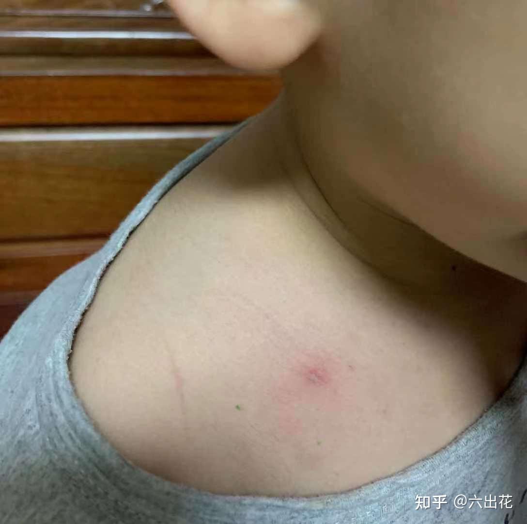 被昆虫(蚊子,蜜蜂,蚂蚁,蜱虫)咬了/蛰了怎么办?
