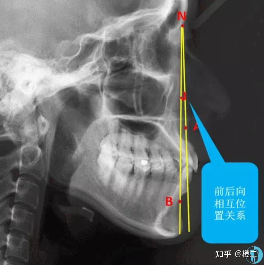 正颌手术真的有必要做吗?正颌术后能否达到标准面型?附正畸or正颌自测 - 知乎