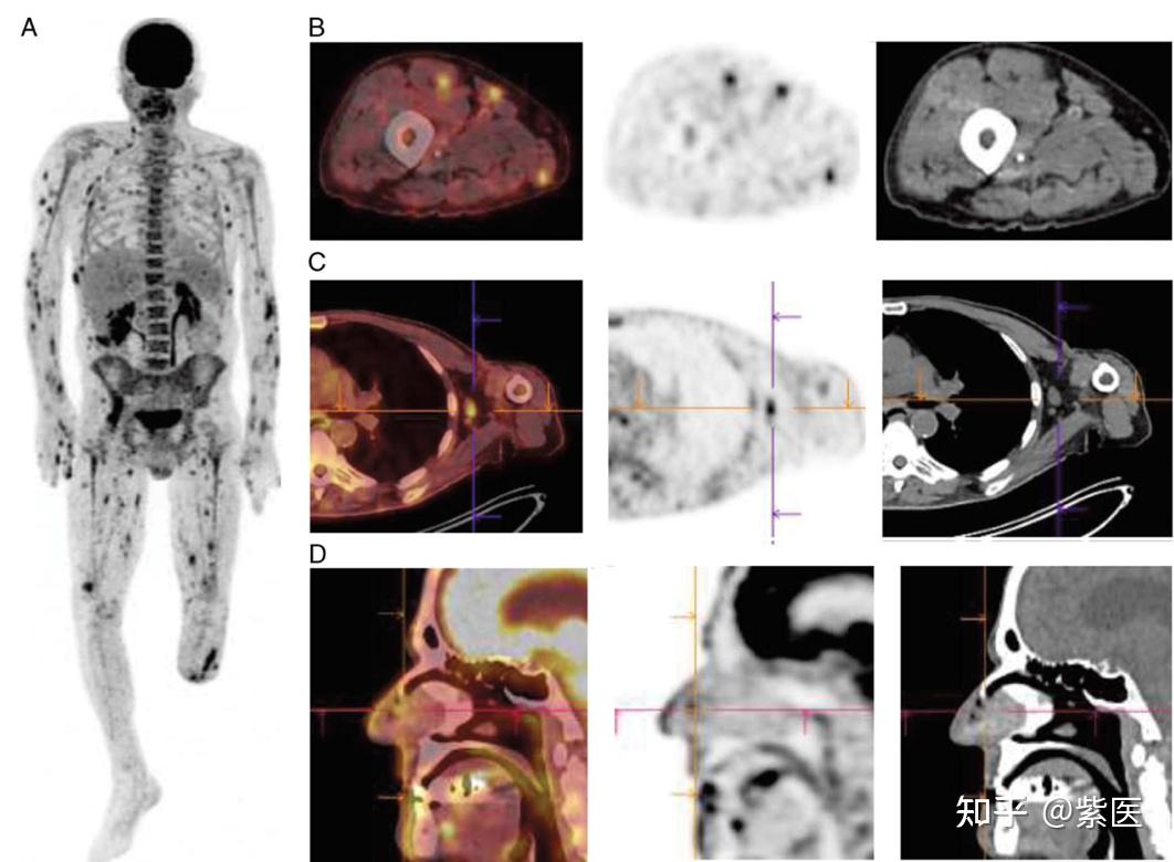 什么?“全身PET/CT” 常规不扫到脚? - 知乎