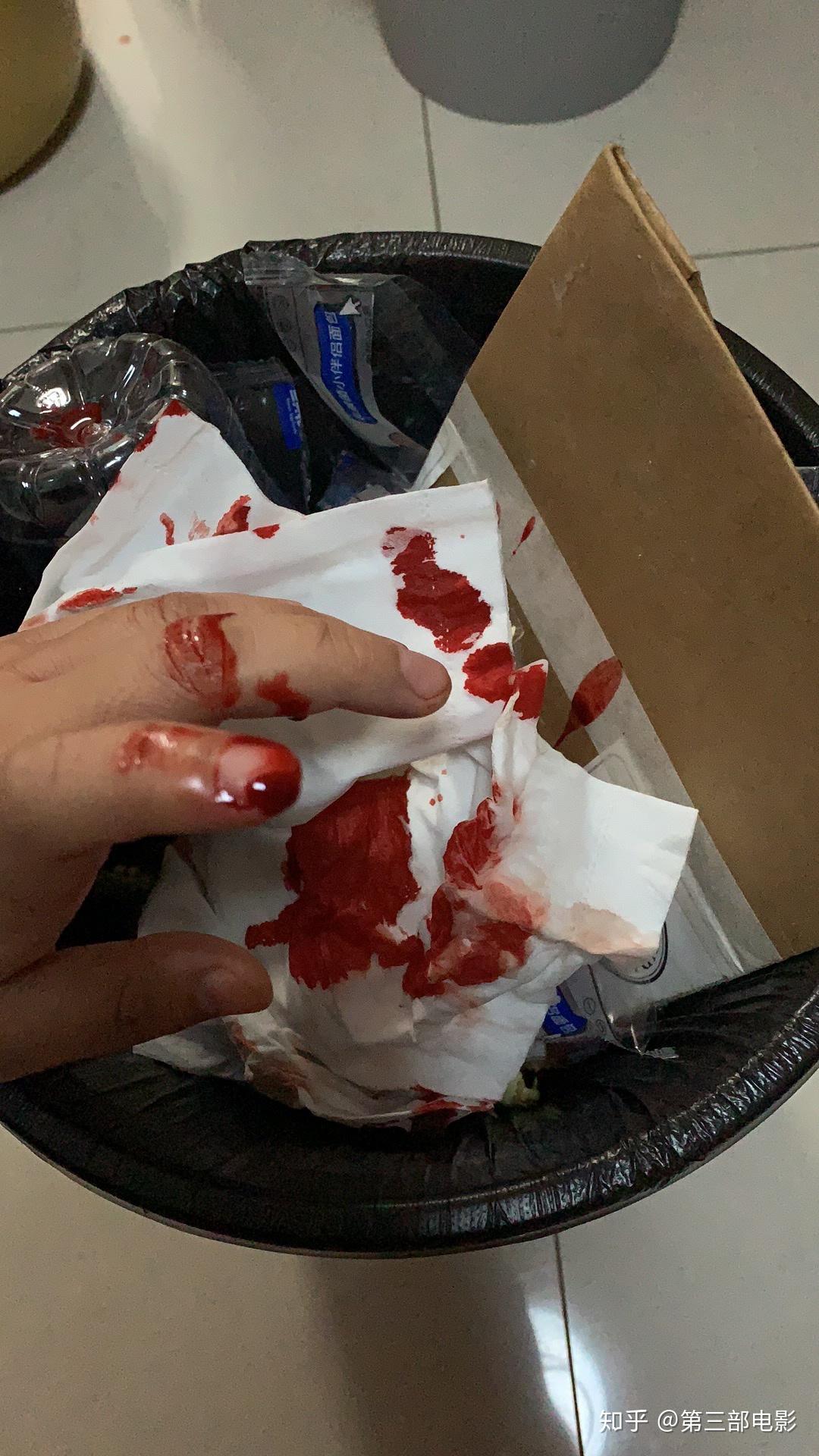 手指被割掉一块肉是什么体验? 