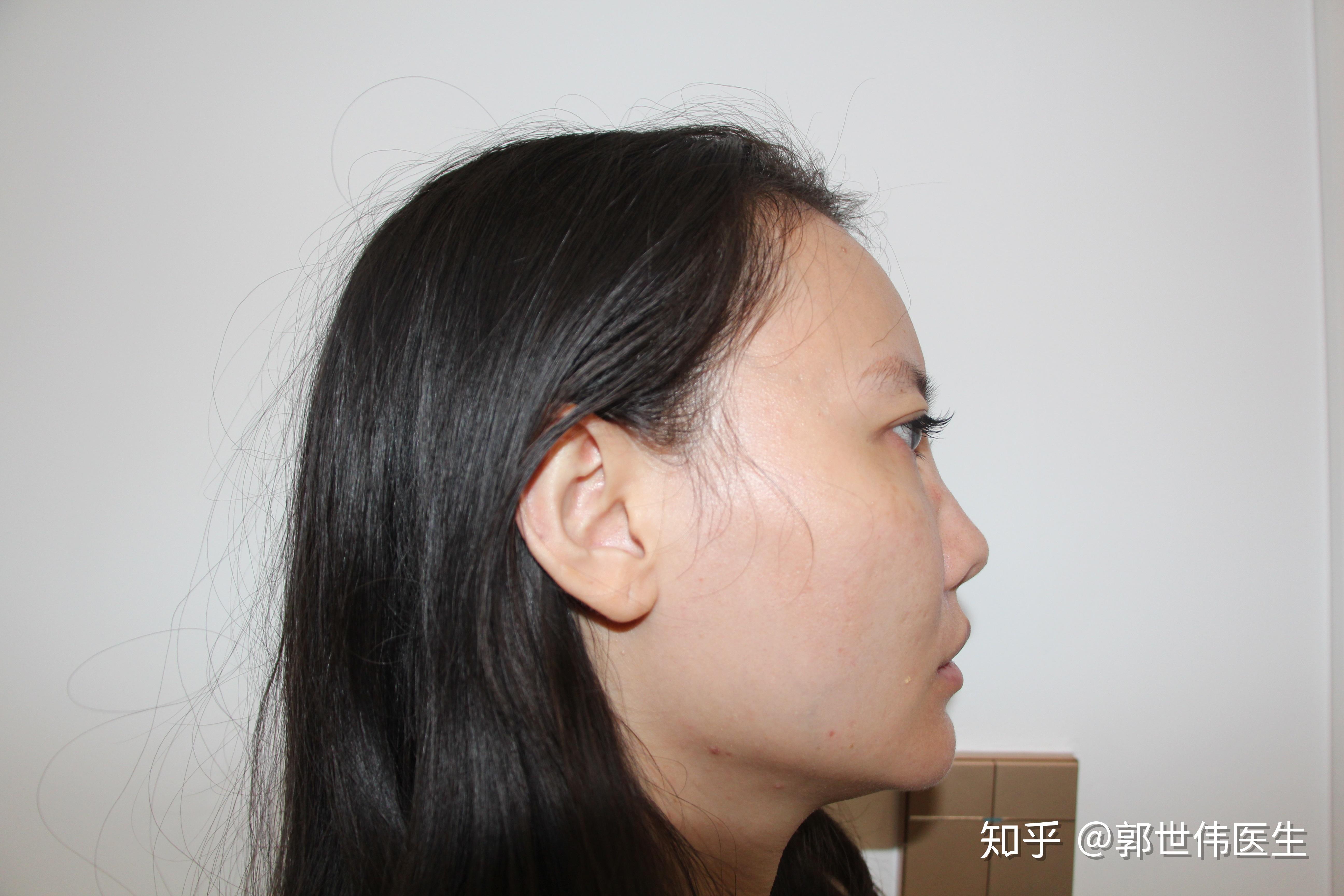 朝天鼻鼻孔巨大能不能自己改善? - 知乎