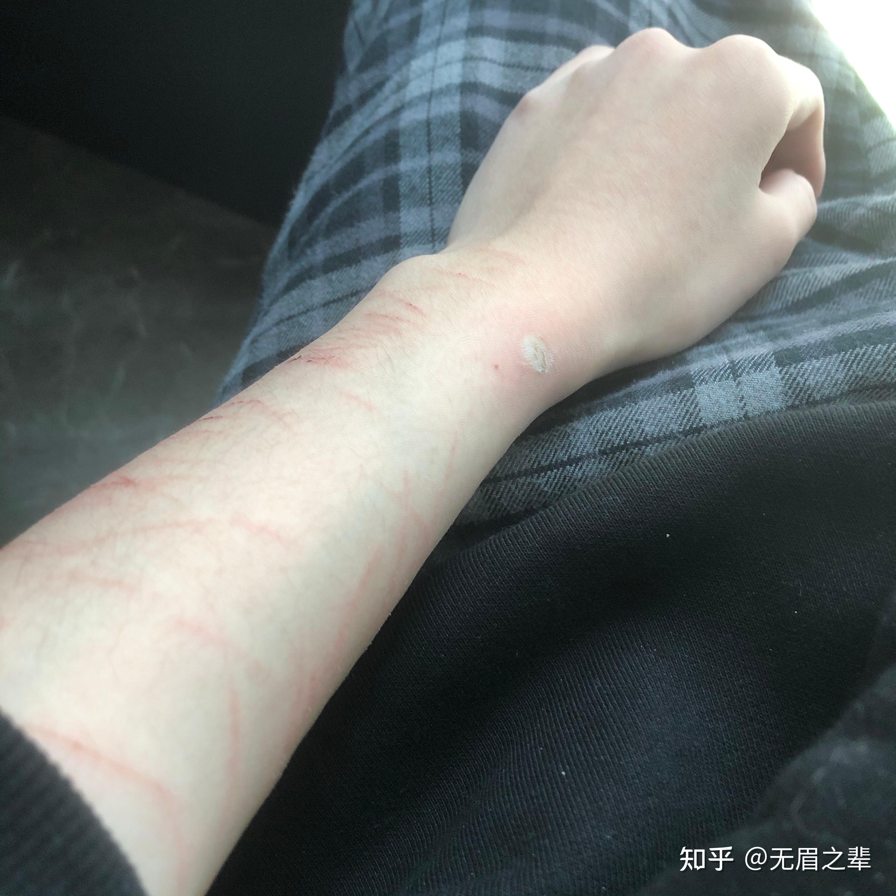 为什么有人会往身上烫烟疤? - 知乎