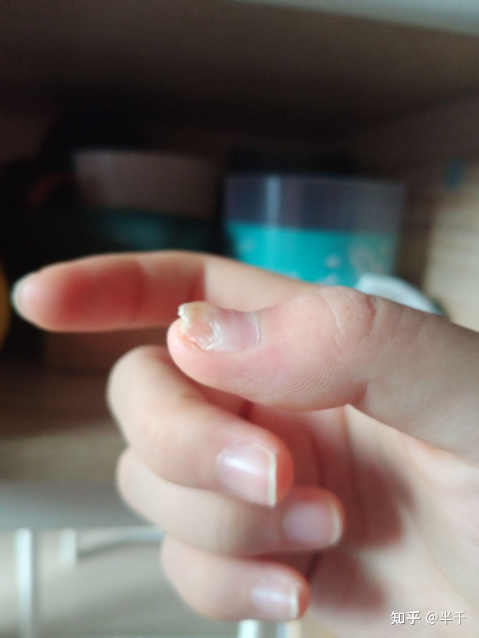 手被门夹了里面黑紫的瘀血 会肿 怎么办啊昨天下午伤的?