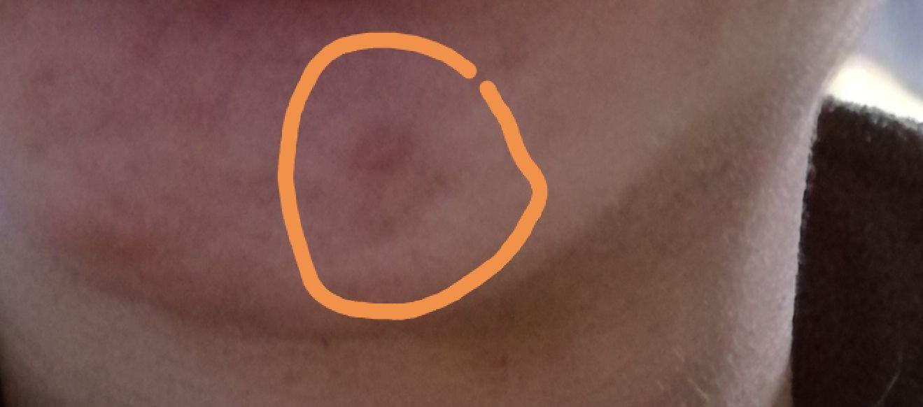 嘴巴边上老长这种白色脓包有什么好的解决方案