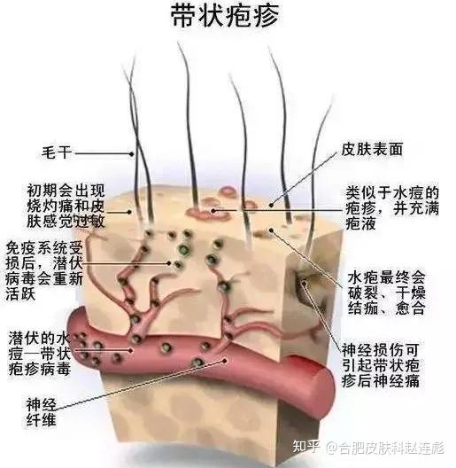 得了带状疱疹的症状及感受是什么? - 知乎