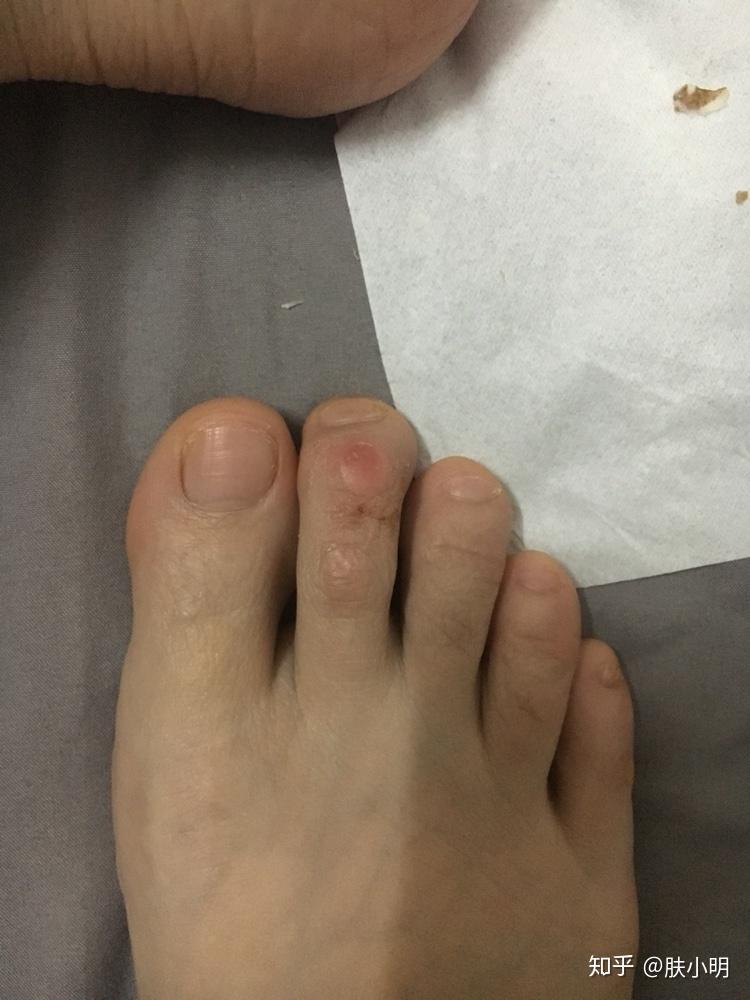 脚上被鞋子磨出茧要怎么办? - 知乎