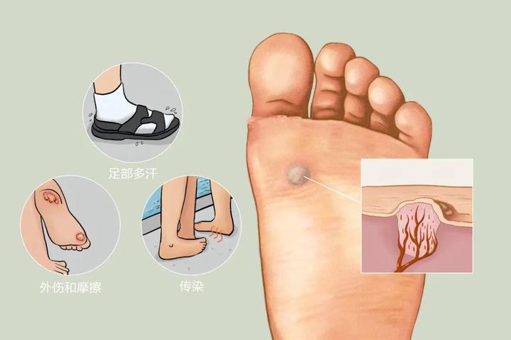 足底跖疣是怎么形成的? - 知乎