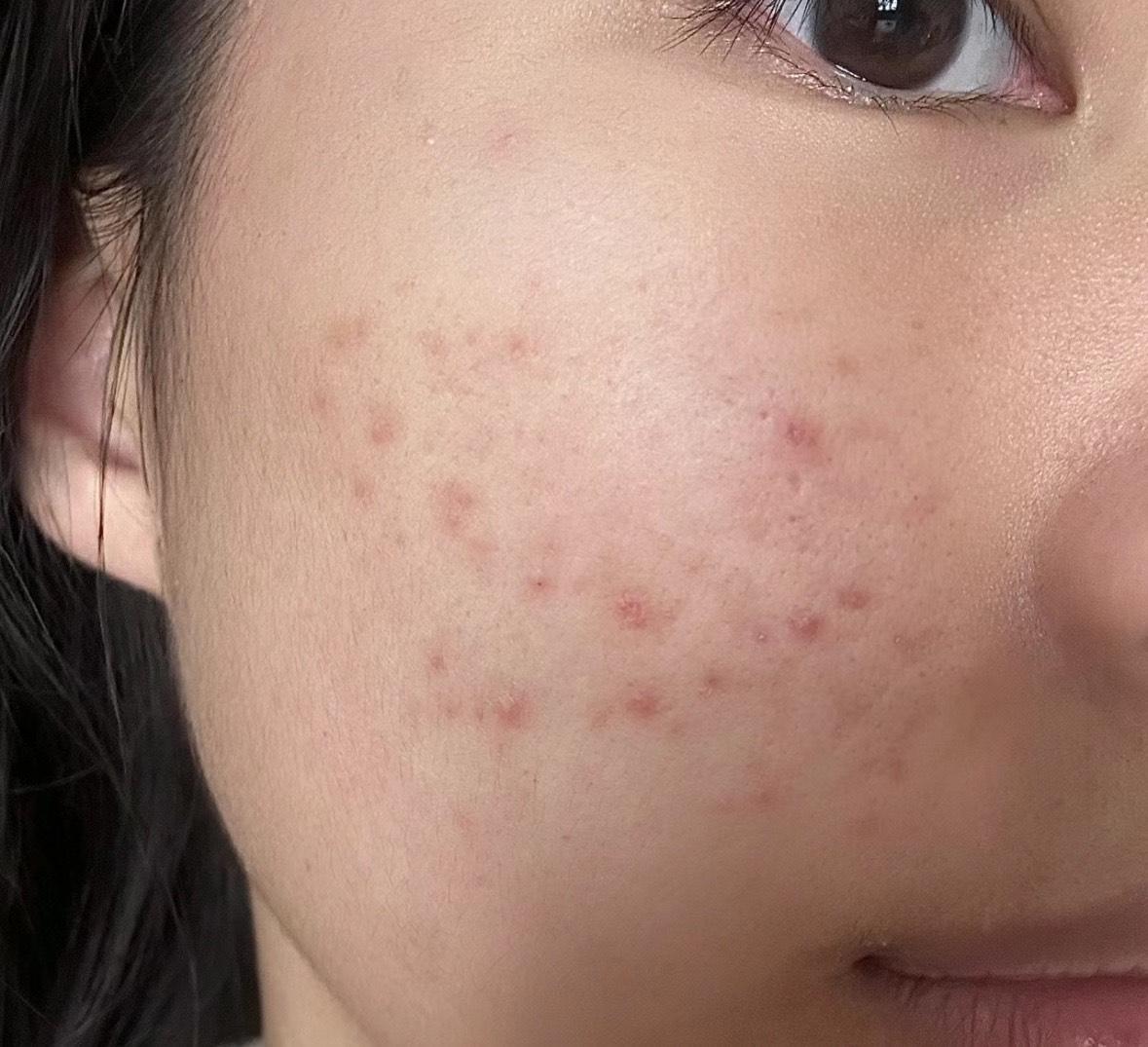 【黑红痘印必看】28天就能消除痘印的4步方法，红色痘印+黑色痘印全部清0，歼灭色沉印子，嫩滑皮肤！