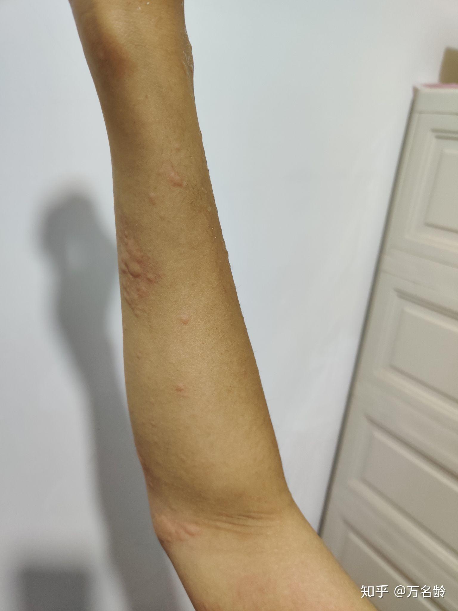 对狗过敏的症状有哪些? - 知乎