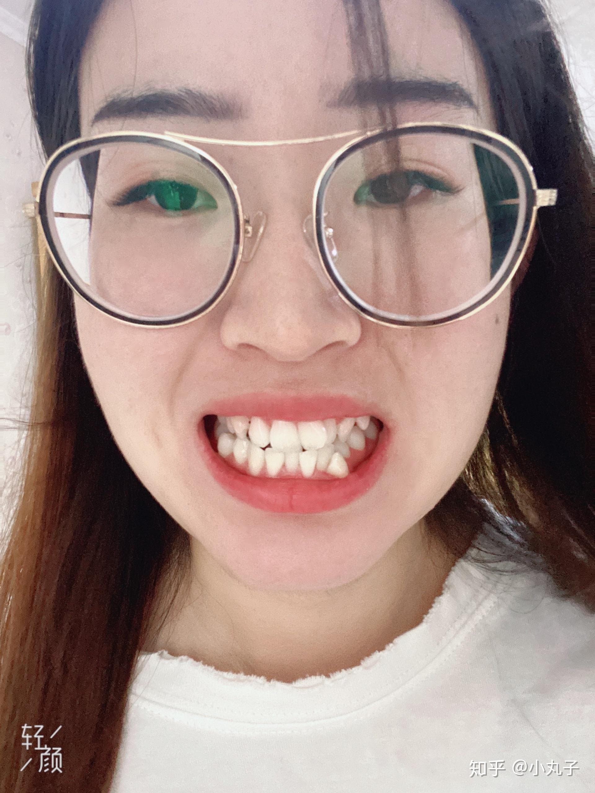 长的好看但是牙齿丑是什么体验