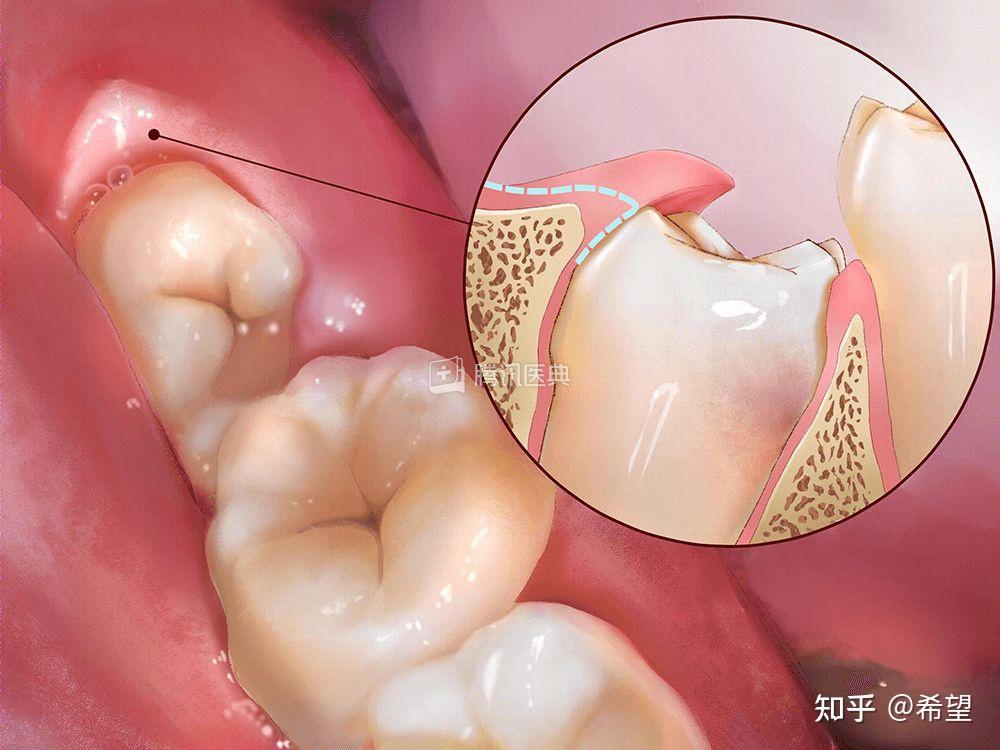 智齒冠周炎吃消炎藥沒用怎麼辦