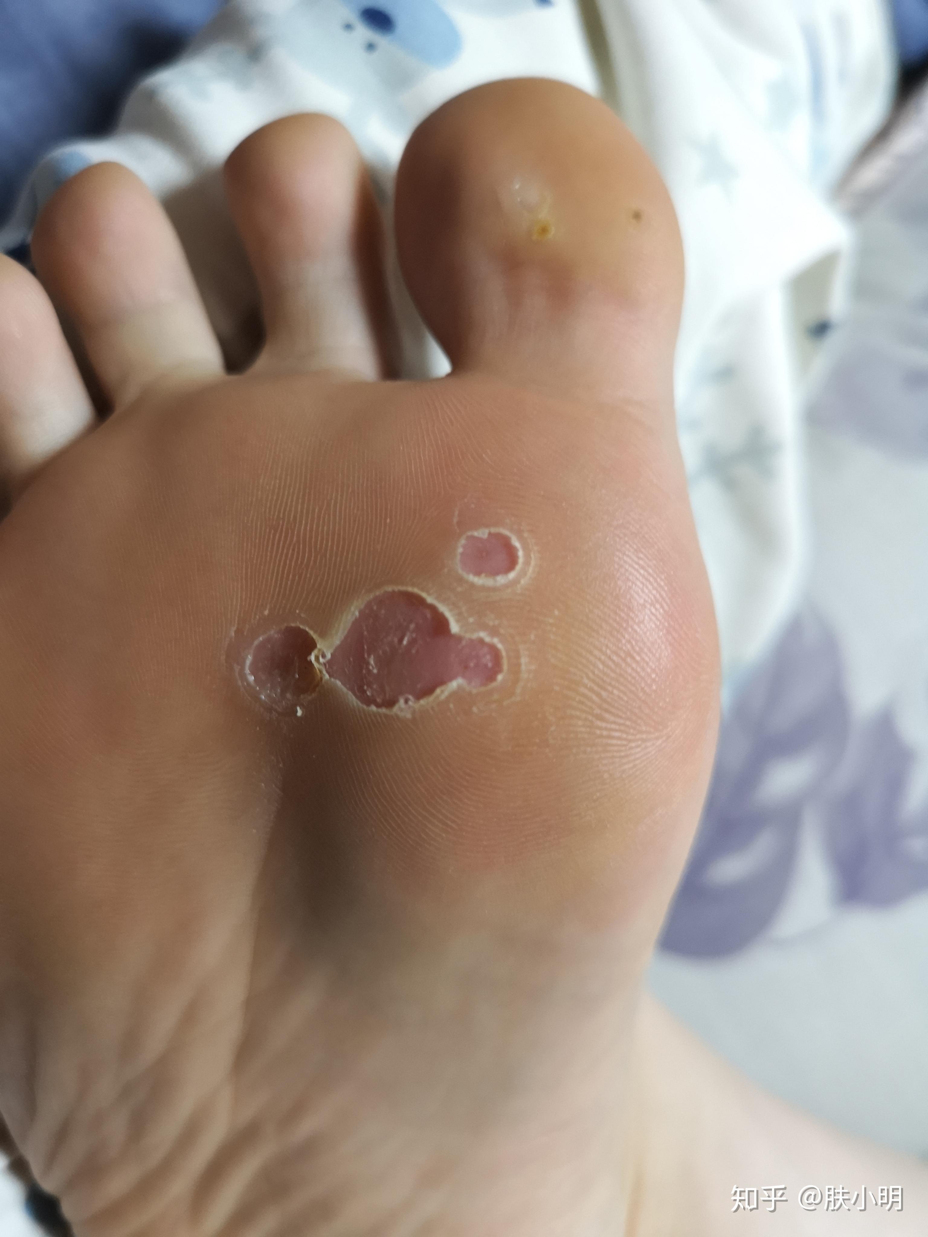 脚底长了两颗跖疣,去药房问了,医生给了瓶除疣液和贴布上面写适用鸡眼