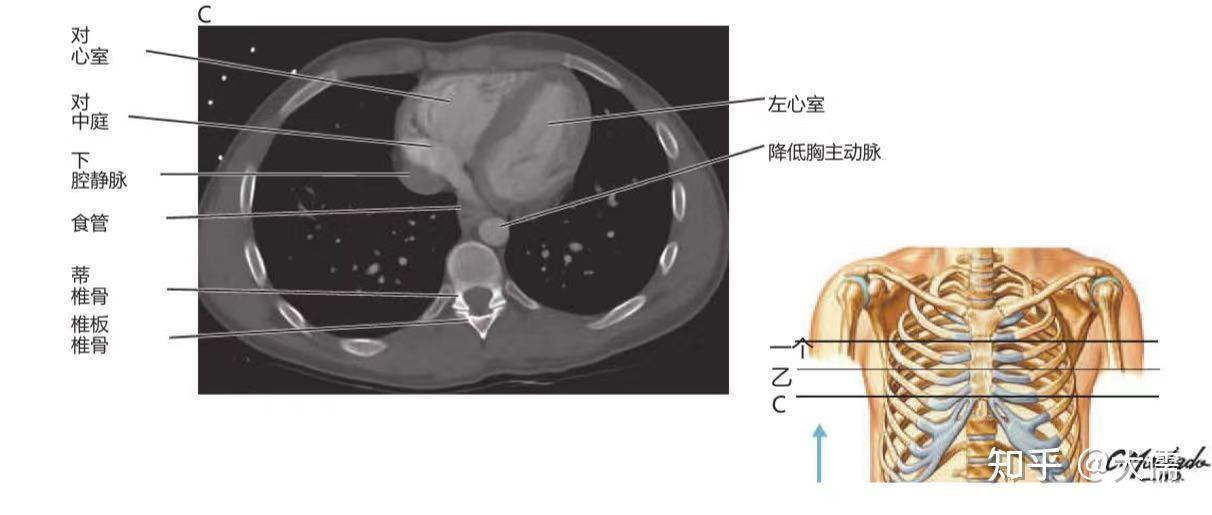 胸部CT报告 - 知乎