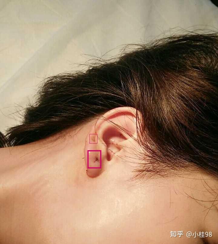 耳垂皮脂腺囊肿手术需要住院吗