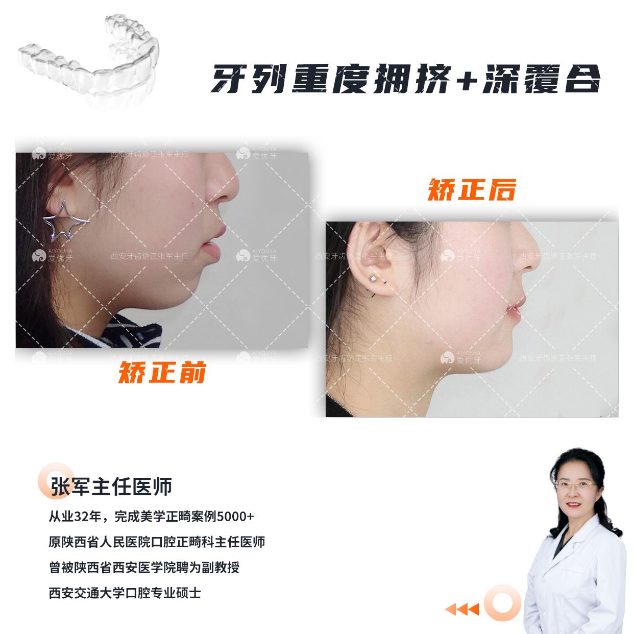 #西安牙齿矫正:不拔牙解决重度拥挤,呈现迷人笑容 - 知乎