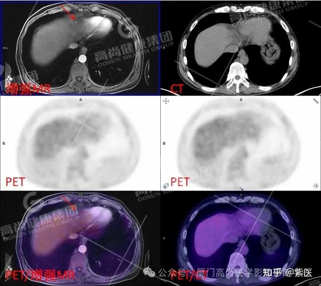 PET/CT-MR 多模态融合技术在临床中的应用病例分享（一） - 知乎