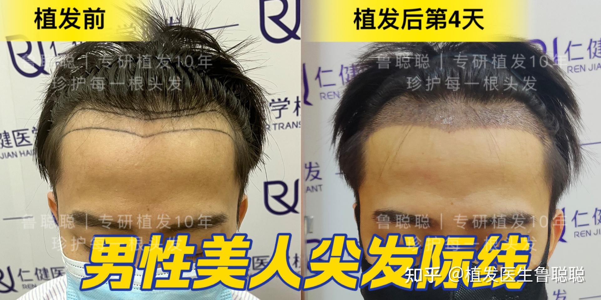 5大发际线样式,你的脸型适合哪个? - 知乎