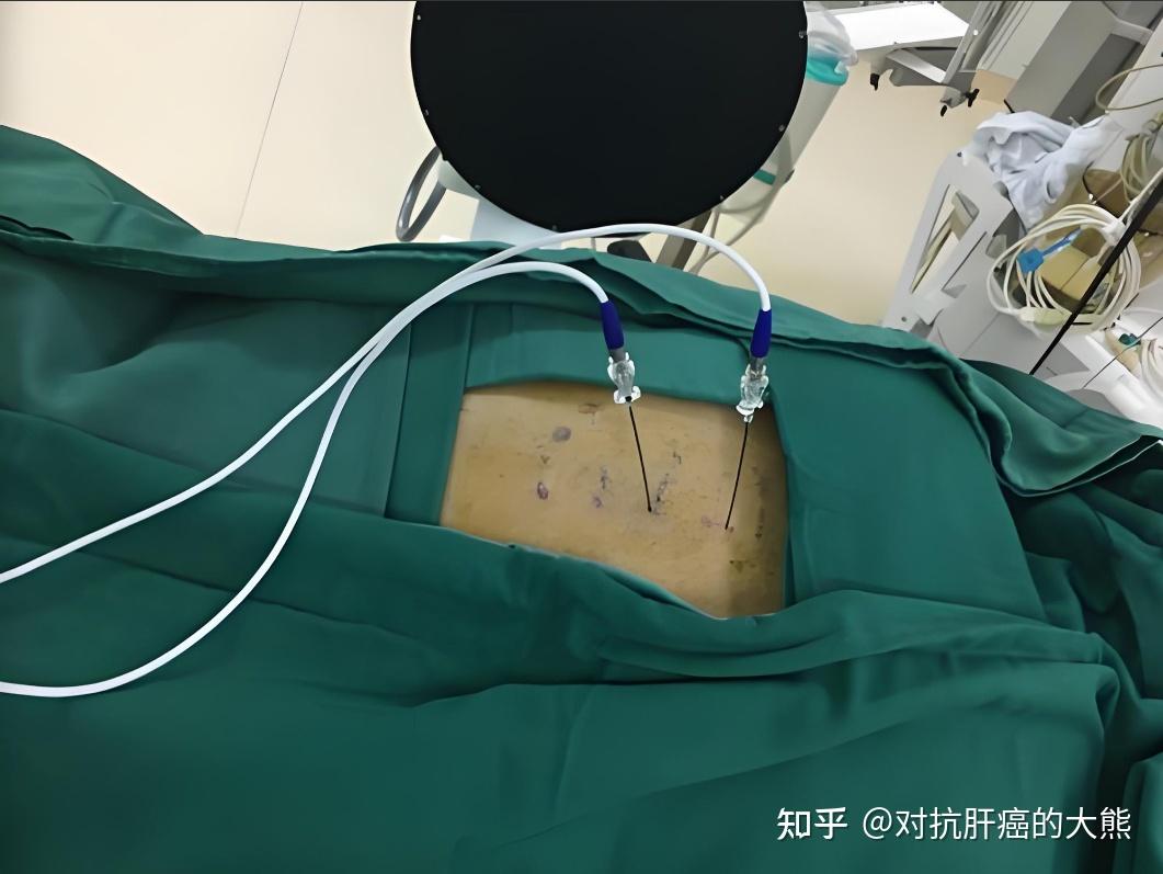 肝癌介入后,碘油“减量”了怎么办?! - 知乎