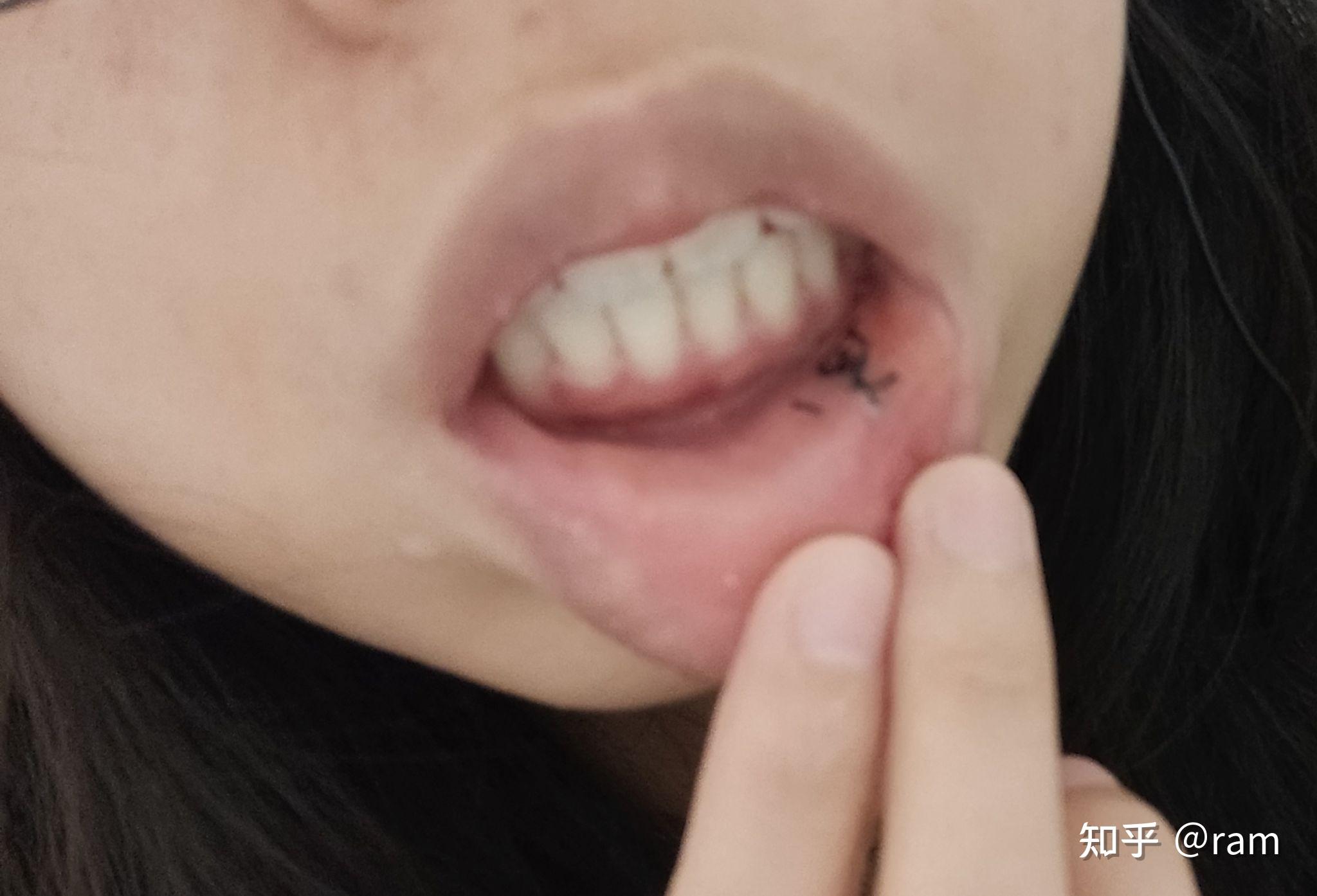 嘴唇粘液腺囊肿手术后?