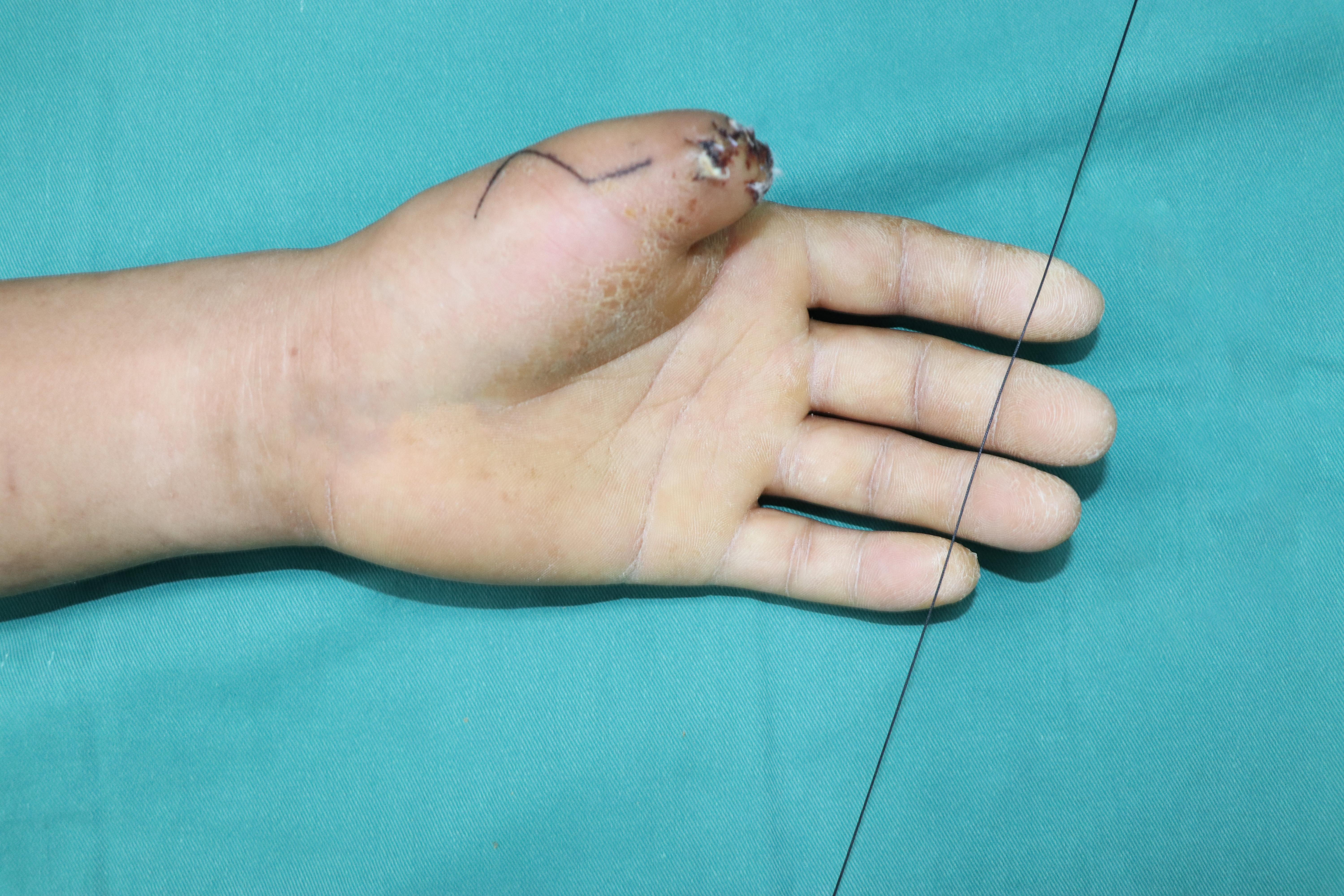 手指再造失败了怎么办?还可以修复吗?