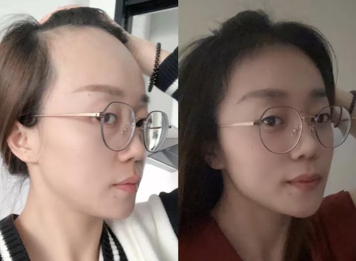 本人植发全过程记录，揭秘植发中不为人知的套路，内附挑选靠谱植发医院医生心得（持续更新） - 知乎