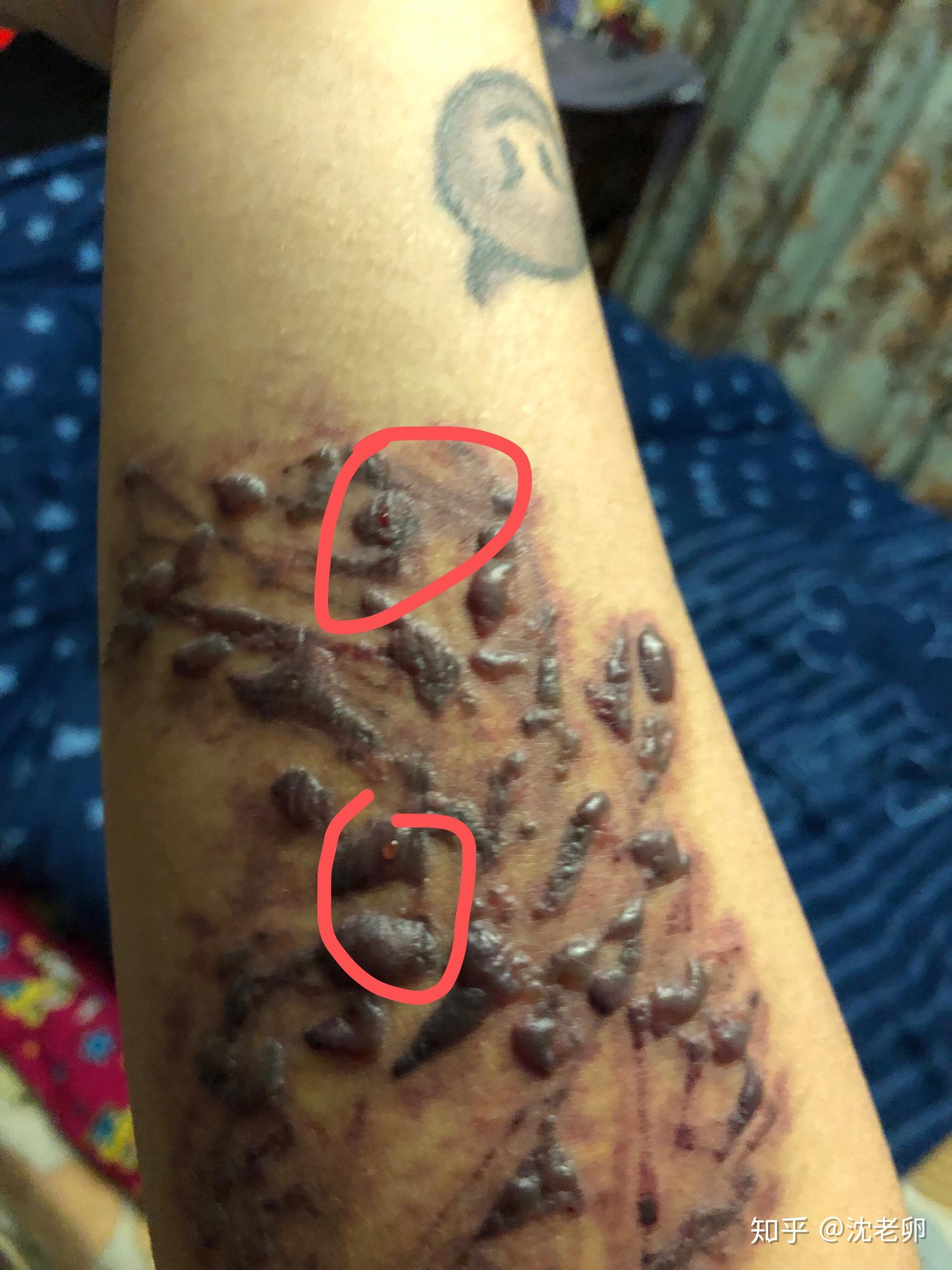 洗纹身起水泡了怎么办