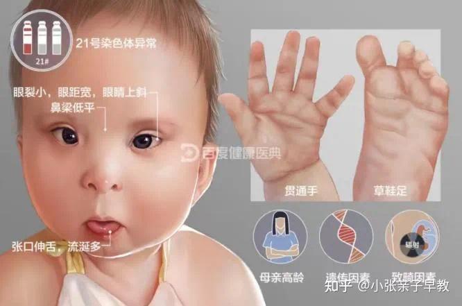 唐氏综合征的症状和好发人群有哪些? - 知乎
