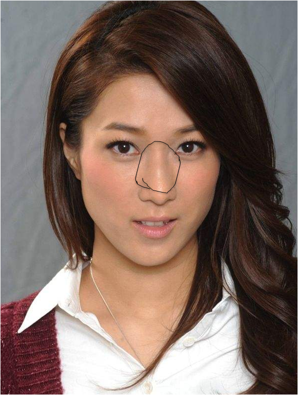 有鼻骨宽的做鼻骨内推手术的吗