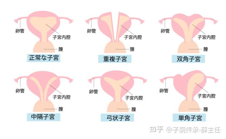 双角子宫影响怀孕吗?