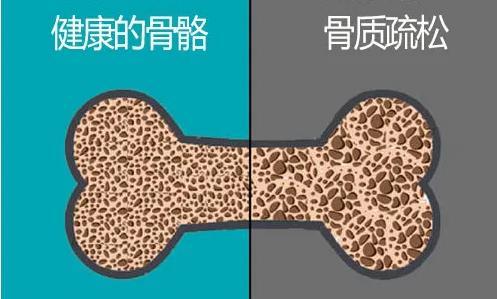 山东国康科普如何才能提高骨密度
