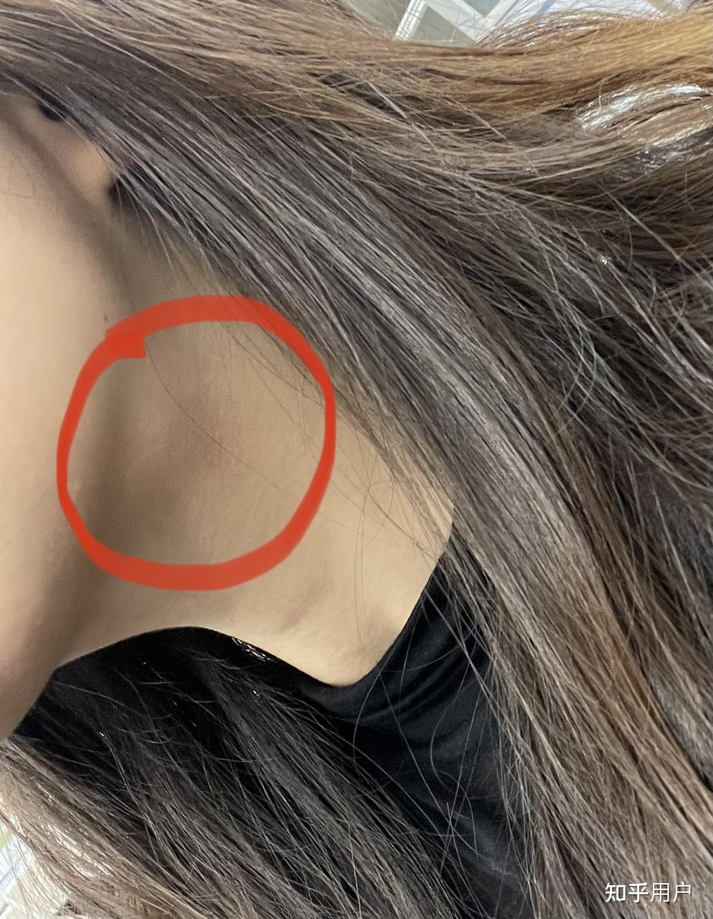 怎么消除催吐后的脸肿(唾液腺肿大)?