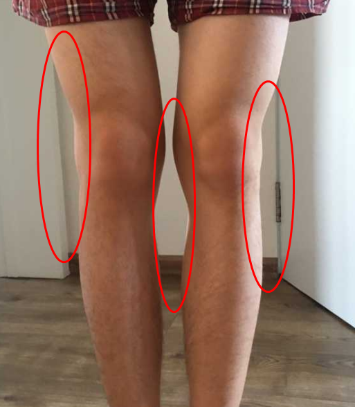 x型腿严重的照片图片