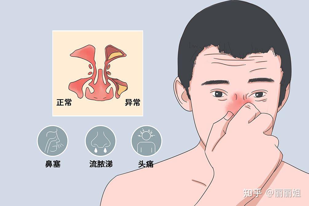 慢性鼻炎怎么治才能好 - 知乎