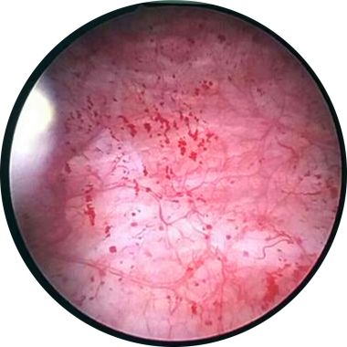 间质性膀胱炎膀胱水扩张术痛苦吗必须做吗