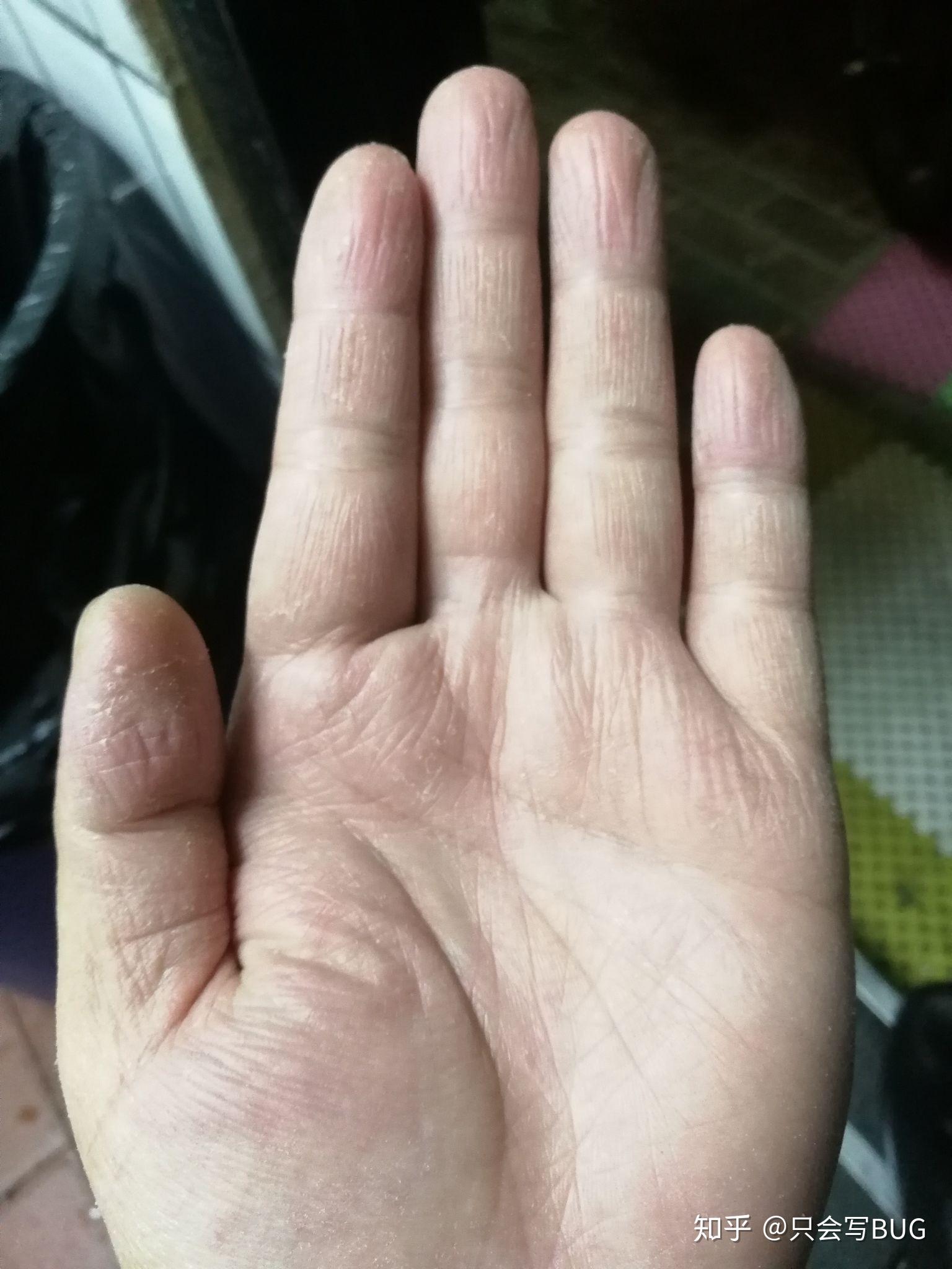 我这手指纹没了,也没有摩擦力是怎么回事?